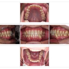 蒲田(矢口渡)のマウスピース矯正(インビザライン矯正)|のびのび歯科・矯正歯科の治療症例