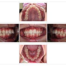 蒲田(矢口渡)のマウスピース矯正(インビザライン矯正)|のびのび歯科・矯正歯科の治療症例