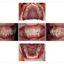 蒲田(矢口渡)のマウスピース矯正(インビザライン矯正)|のびのび歯科・矯正歯科の治療症例