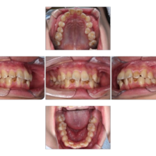 蒲田(矢口渡)のマウスピース矯正(インビザライン矯正)|のびのび歯科・矯正歯科の治療症例